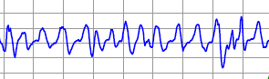 irregular rhythm